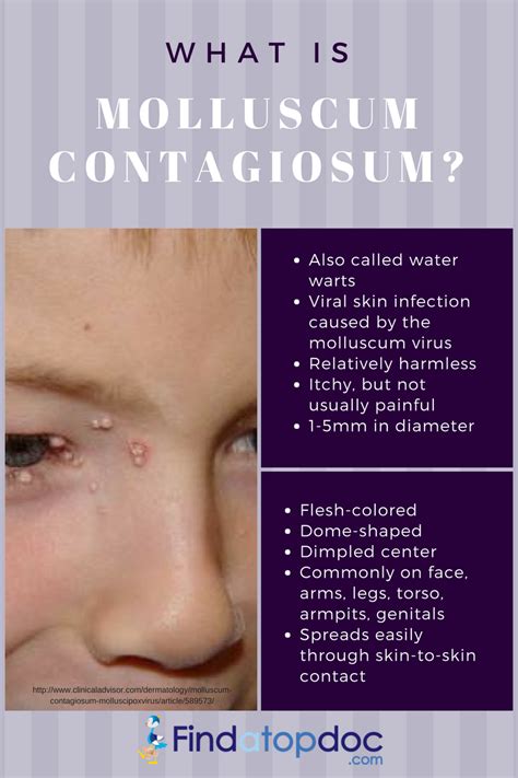 mollycum|About Molluscum Contagiosum .